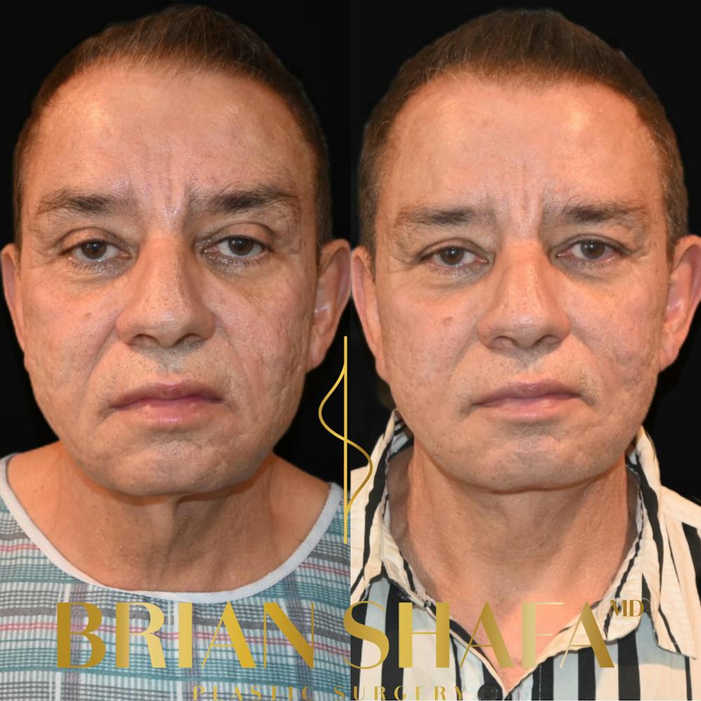 Facelift/Necklift Before & After Photos - Patient 235154 - Image 1