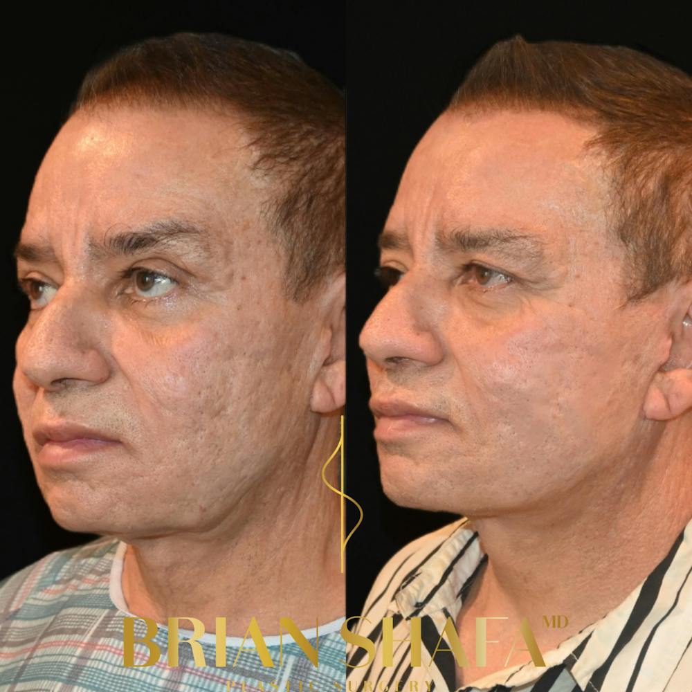 Facelift/Necklift Before & After Photos - Patient 235154 - Image 2