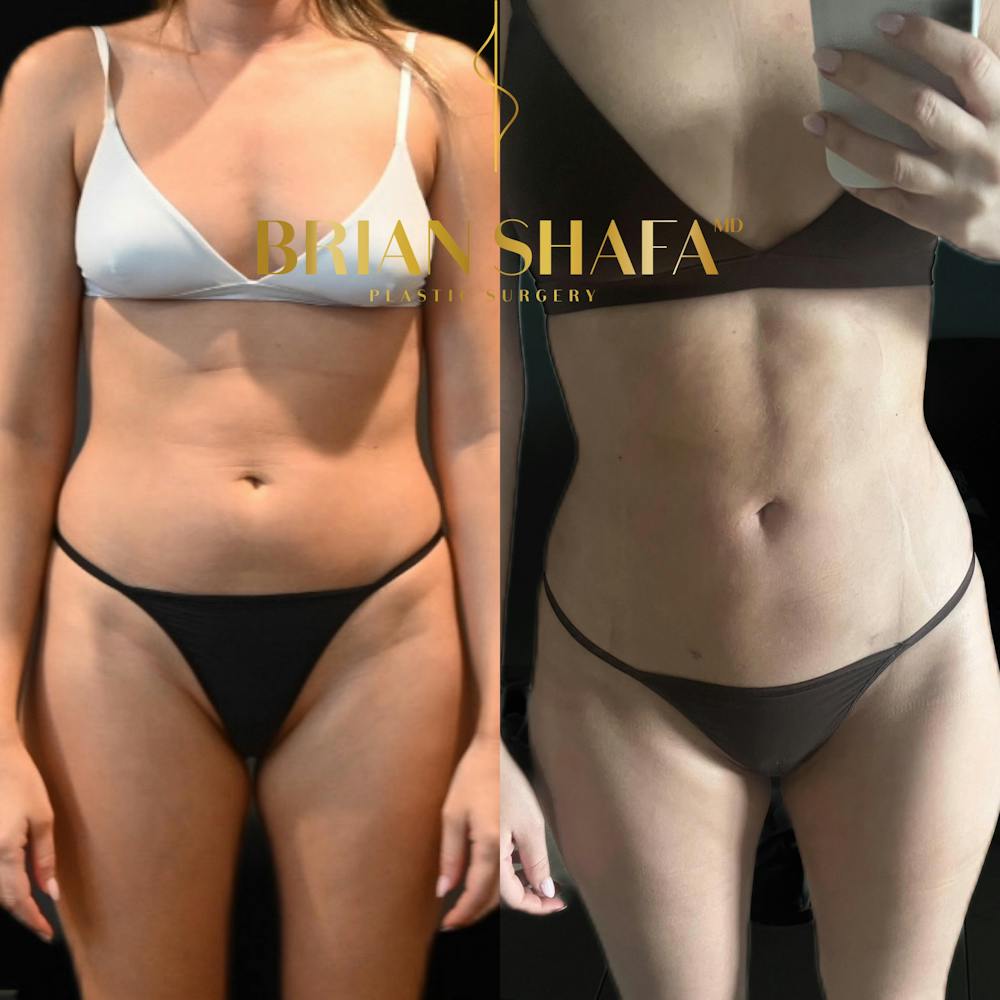 Lux Lipo Before & After Photos - Patient 198257 - Image 1
