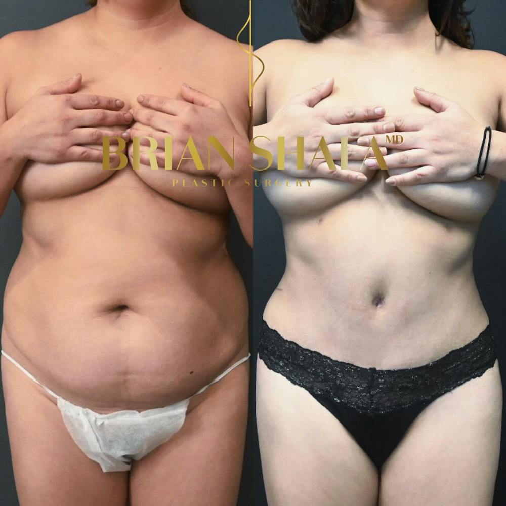 Lux Tuck Before & After Photos - Patient 315872 - Image 1