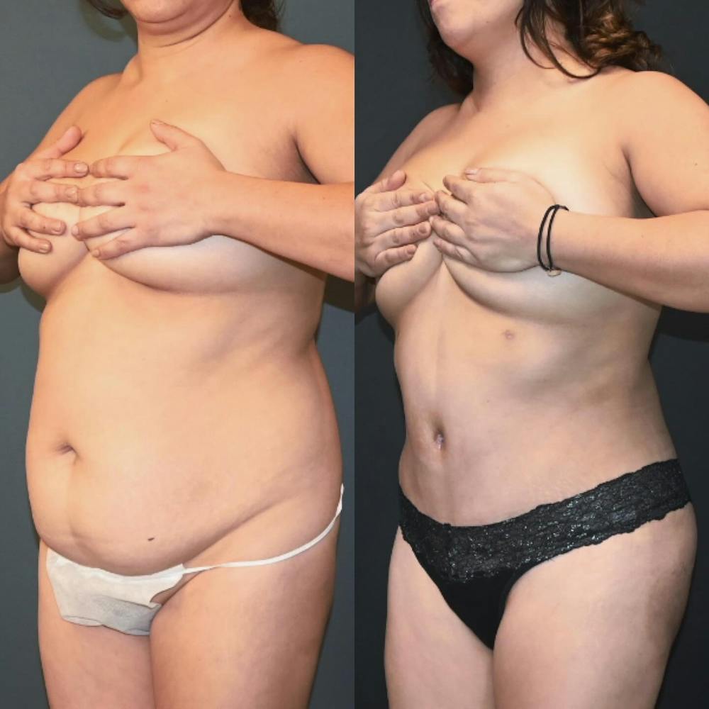 Lux Tuck Before & After Photos - Patient 315872 - Image 2