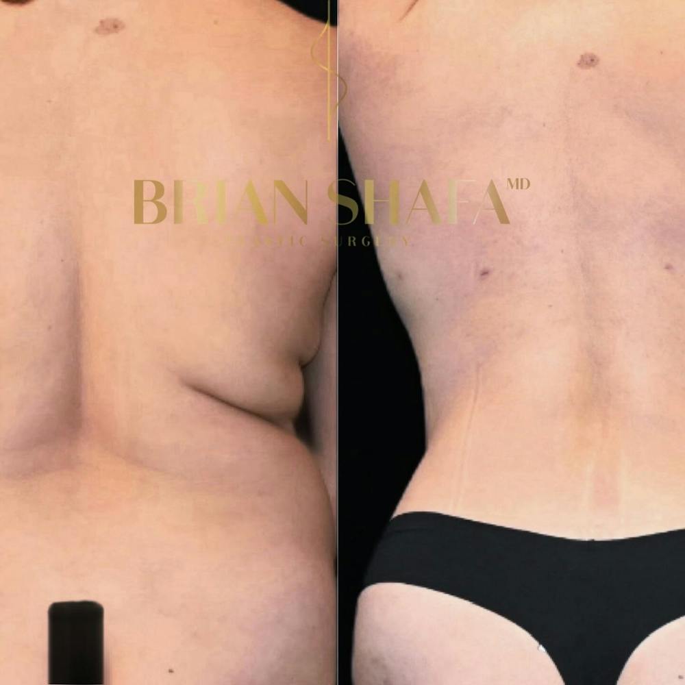 Lux Tuck Before & After Photos - Patient 315872 - Image 3