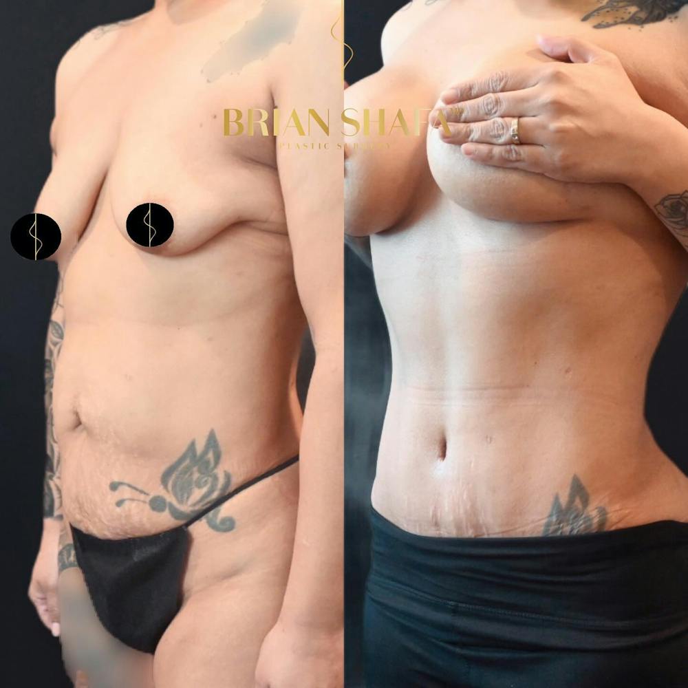 Mommy Makeover Before & After Photos - Patient 389079 - Image 2