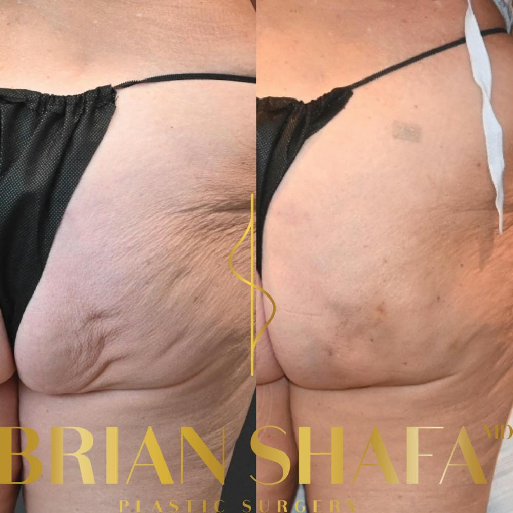 Avéli™ Cellulite Reduction Before & After Photos - Patient 354678 - Image 1