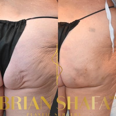 Avéli™ Cellulite Reduction Before & After Photos - Patient 354678 - Image 1