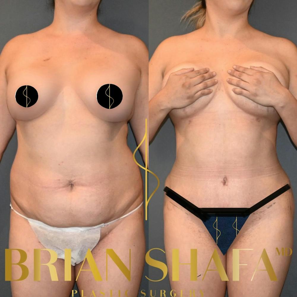 Mommy Makeover Before & After Photos - Patient 152782 - Image 1