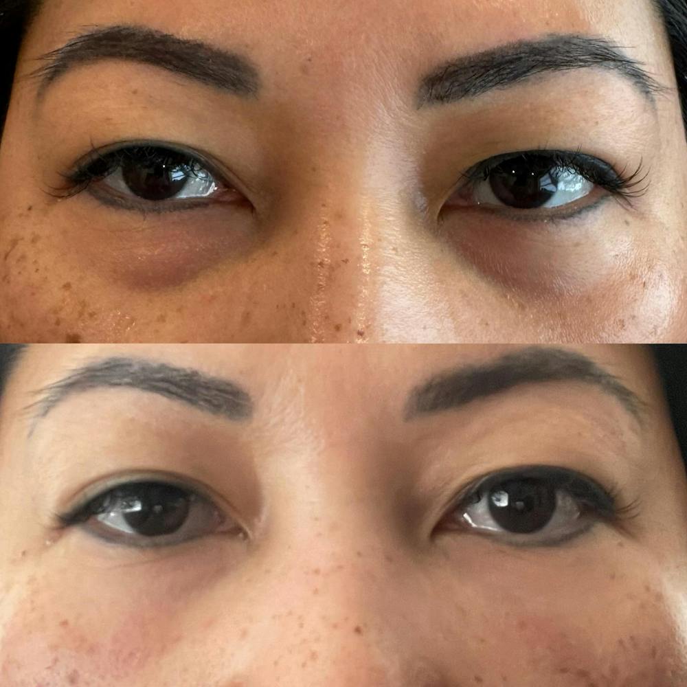 Injectables Before & After Photos - Patient 126797 - Image 1