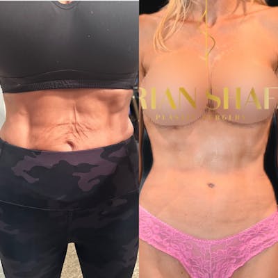 Reverse Tummy Tuck Before & After Photos - Patient 456404 - Image 1