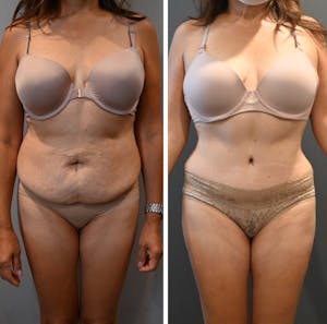 Mommy makeover procedure before and after
