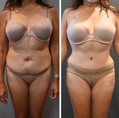 Tummy Tuck (Abdominoplasty) Before & After Photos - Patient 143502966 - Image 1