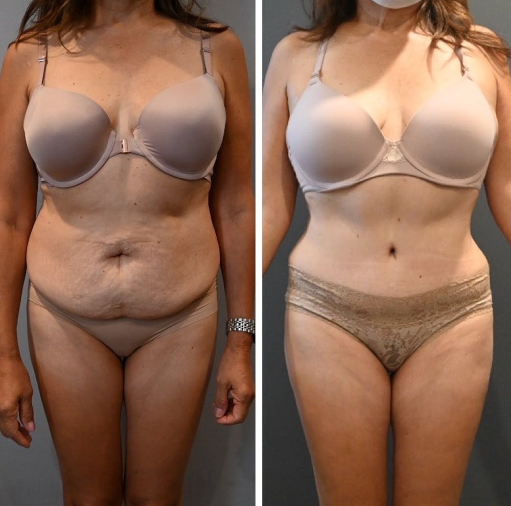 Tummy Tuck (Abdominoplasty) Before & After Photos - Patient 143502966 - Image 1