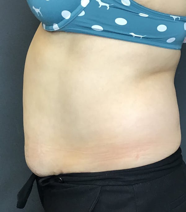 Body Contouring Before & After Gallery - Patient 10602236 - Image 4