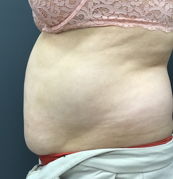 Body Contouring