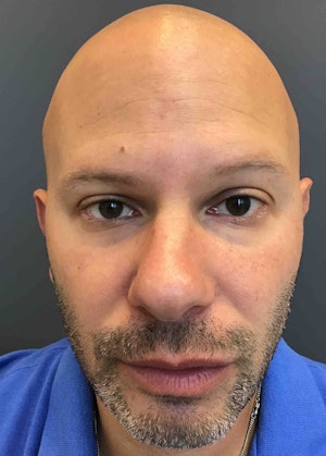 Facial Fillers for Men