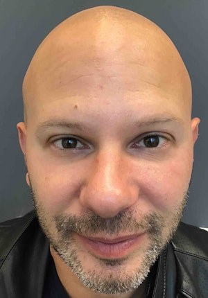 Facial Fillers for Men