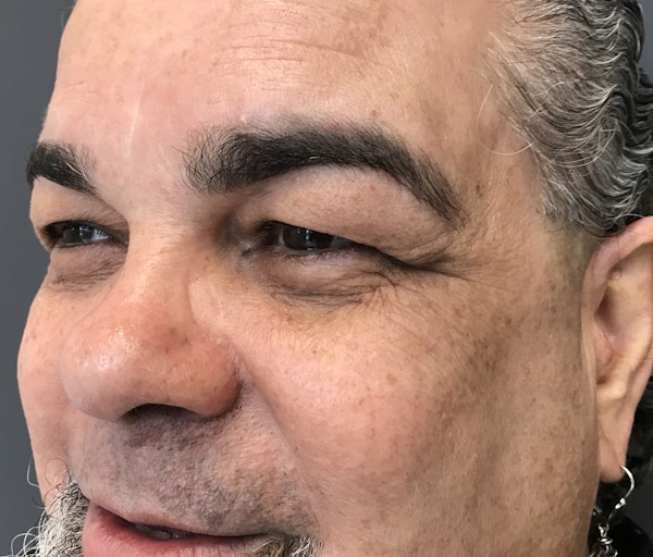 Botox for Men