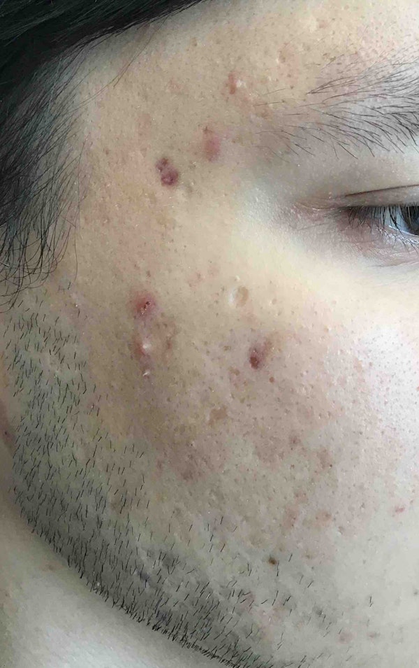 PRP Facial Rejuvenation results in Brooklyn from Juno Aesthetics