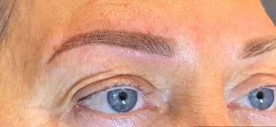 Permanent makeup Before & After Gallery - Patient 10670337 - Image 2