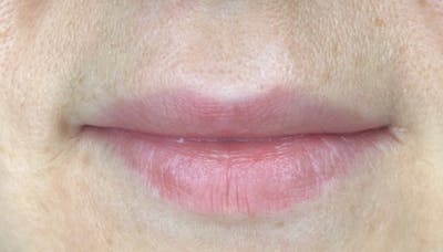 Permanent makeup Before & After Gallery - Patient 10670338 - Image 1
