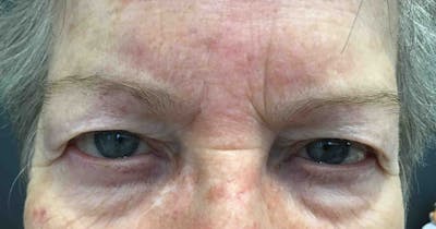 Botox Before & After Gallery - Patient 20544161 - Image 1