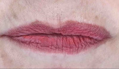 Fillers Before & After Gallery - Patient 29481926 - Image 1