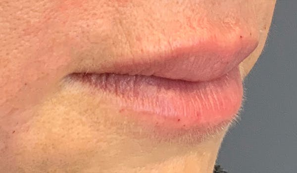 Fillers Before & After Gallery - Patient 29481925 - Image 6