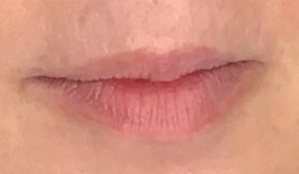 Fillers Before & After Gallery - Patient 29481927 - Image 1