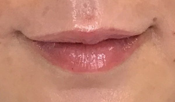 Fillers Before & After Gallery - Patient 29481927 - Image 2