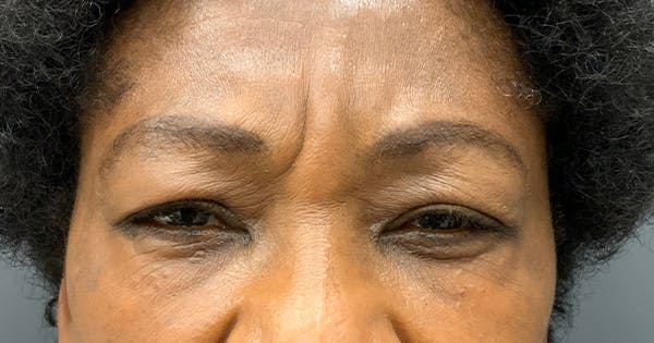 Botox Before & After Gallery - Patient 39901981 - Image 1