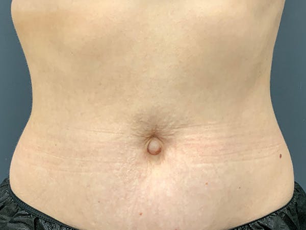 Body Contouring Before & After Gallery - Patient 146166530 - Image 2