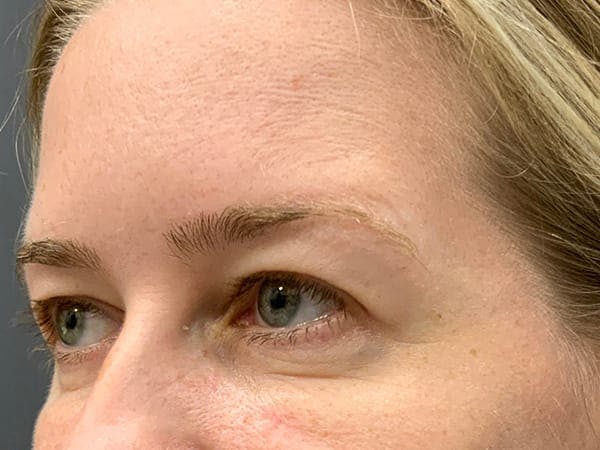 Botox Before & After Gallery - Patient 390648 - Image 10