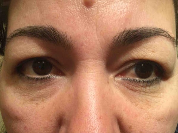 Blepharoplasty Before & After Gallery - Patient 269301 - Image 1