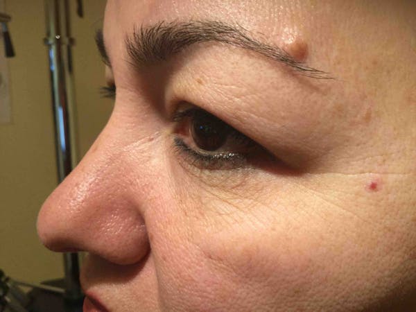 Blepharoplasty Before & After Gallery - Patient 269301 - Image 3