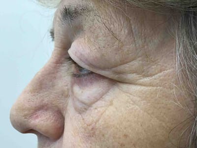 Blepharoplasty Before & After Gallery - Patient 160486 - Image 1