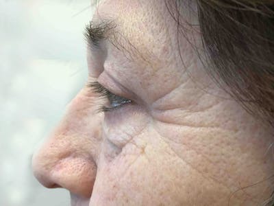Blepharoplasty Before & After Gallery - Patient 160486 - Image 2