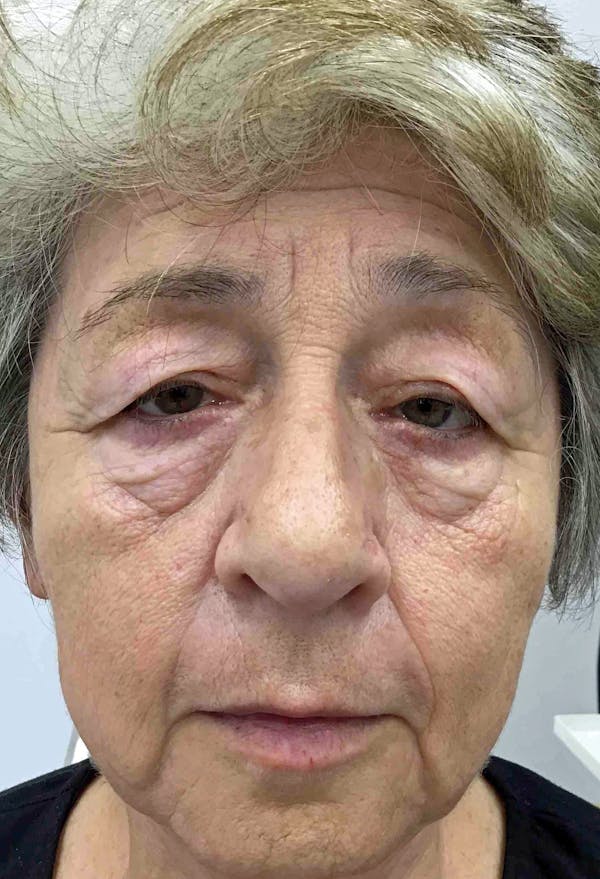 Blepharoplasty Before & After Gallery - Patient 160486 - Image 3