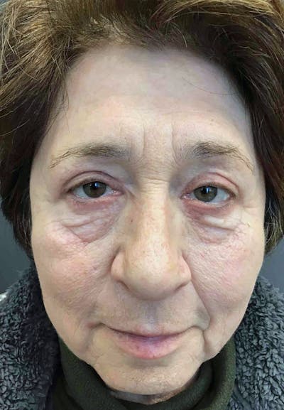 Blepharoplasty Before & After Gallery - Patient 160486 - Image 4