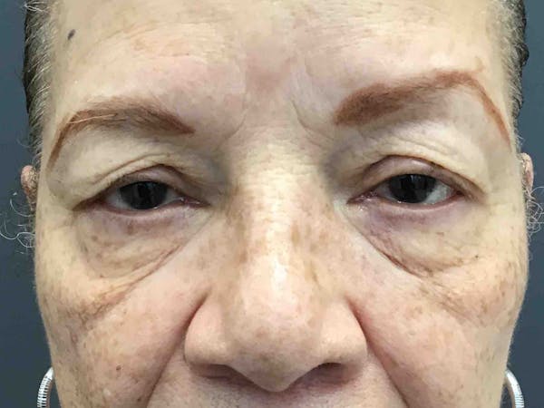 Blepharoplasty Before & After Gallery - Patient 420037 - Image 1