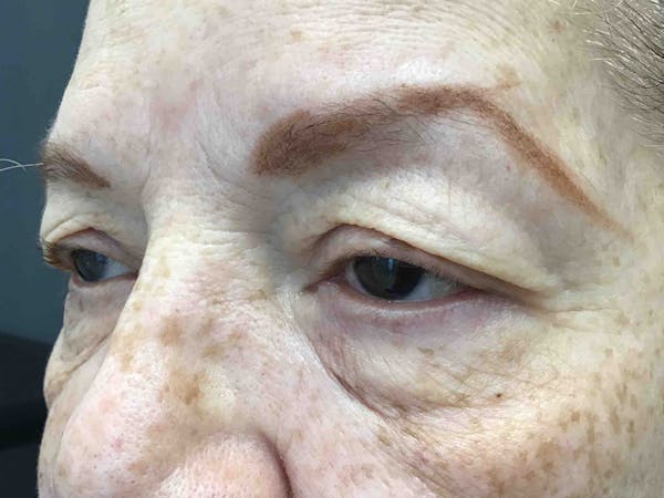 Blepharoplasty Before & After Gallery - Patient 420037 - Image 3