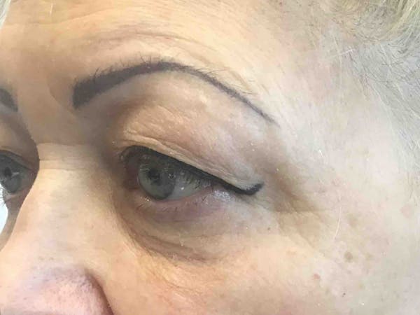 Blepharoplasty Before & After Gallery - Patient 399403 - Image 2