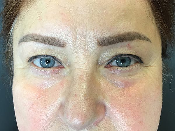 Blepharoplasty Before & After Gallery - Patient 352557 - Image 1