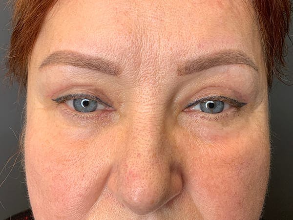 Blepharoplasty Before & After Gallery - Patient 352557 - Image 2