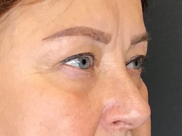 Blepharoplasty Before & After Gallery - Patient 352557 - Image 5