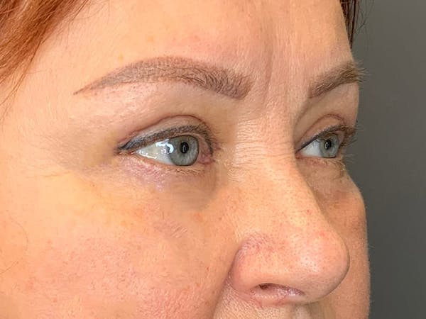 Blepharoplasty Before & After Gallery - Patient 352557 - Image 6