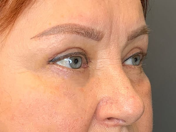 Blepharoplasty Before & After Gallery - Patient 352557 - Image 6