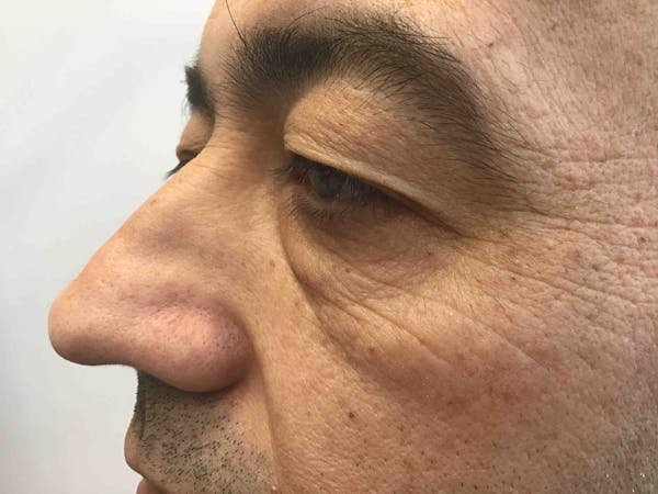 Blepharoplasty Before & After Gallery - Patient 140395 - Image 3