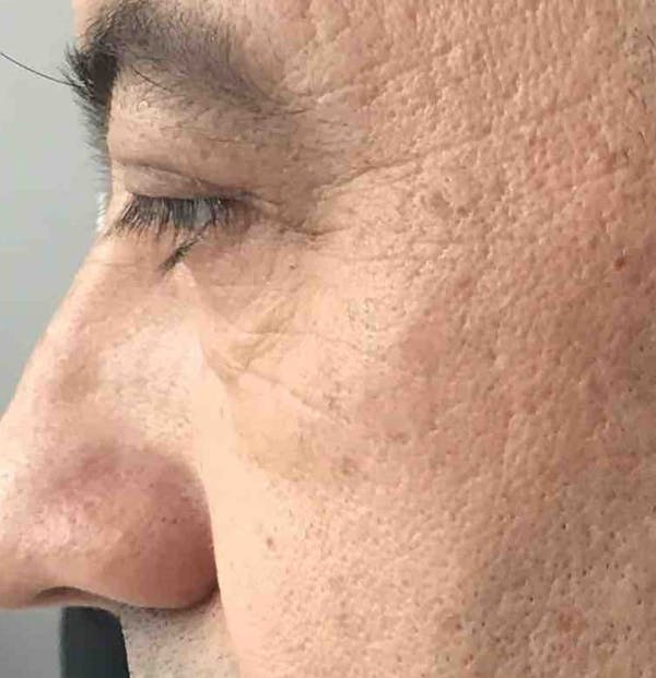 Blepharoplasty Before & After Gallery - Patient 140395 - Image 4