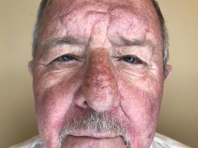 Blepharoplasty Before & After Gallery - Patient 189212 - Image 1