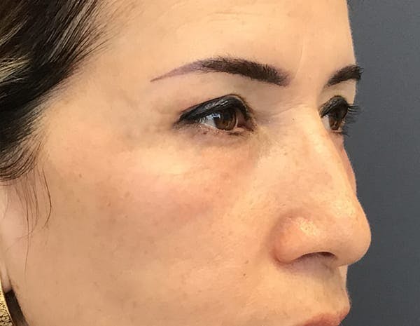 Blepharoplasty Before & After Gallery - Patient 306940 - Image 2