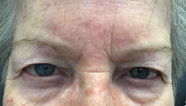 Blepharoplasty Before & After Gallery - Patient 716725 - Image 1